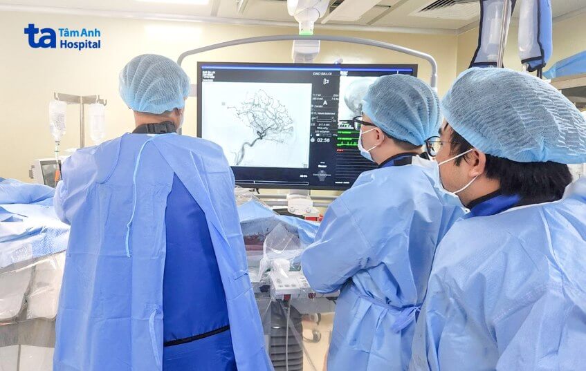 thuyên tắc mạch điều trị đột quỵ xuất huyết não