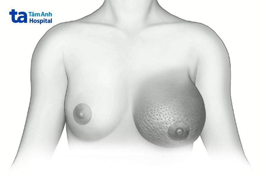 triệu chứng ung thư vú dạng viêm