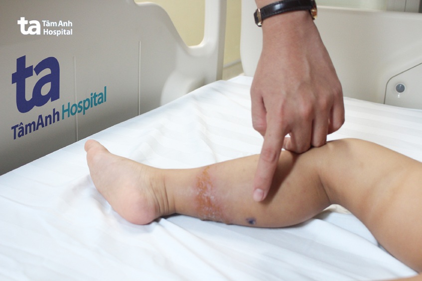 Từ một nốt ban đỏ, bé gái sưng, lan xung quanh chân