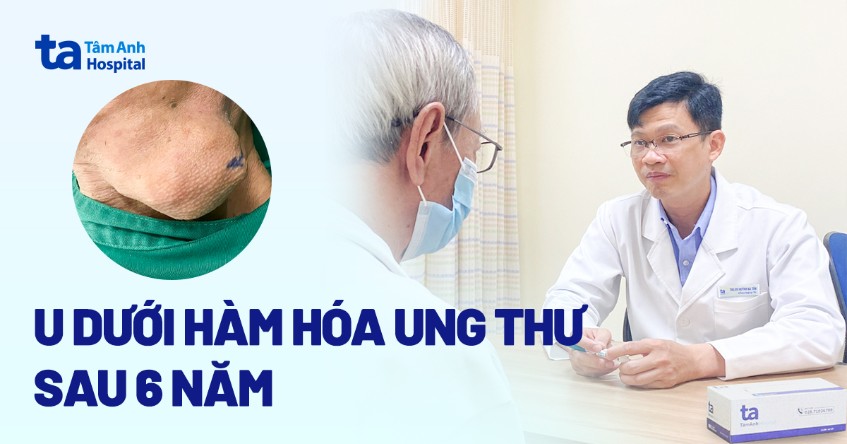 U dưới hàm hóa ung thư giai đoạn 3 sau 6 năm