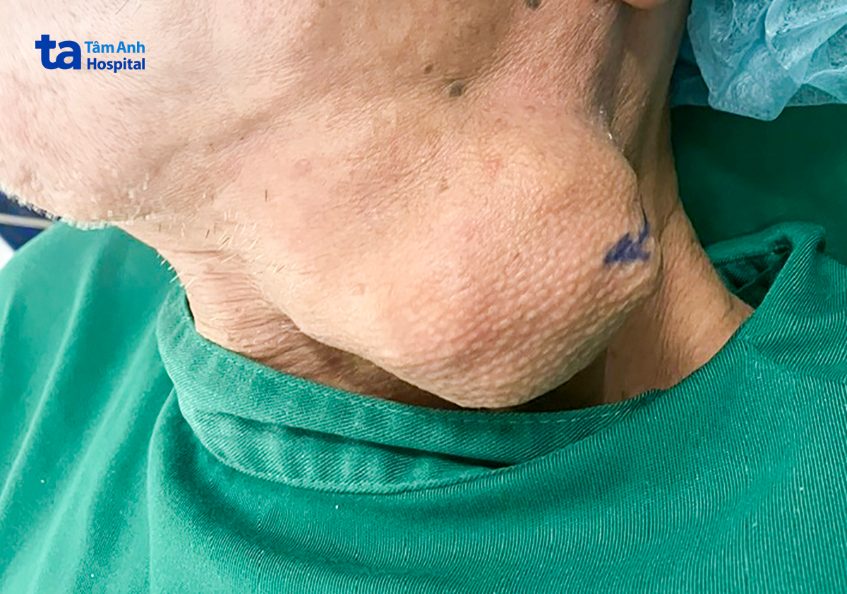 U tăng 12cm trong 2 tháng