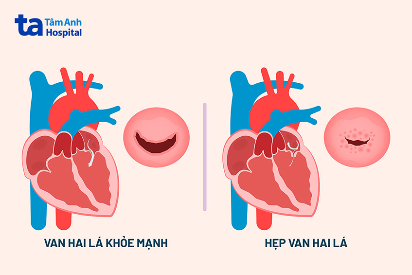 Van hai lá bị hẹp khít cần được chỉ định thay van