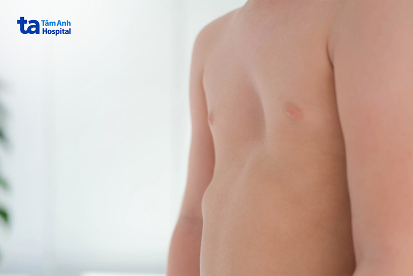 Vết lõm vào ngay giữa ngực có thể gây chèn ép tim, phổi