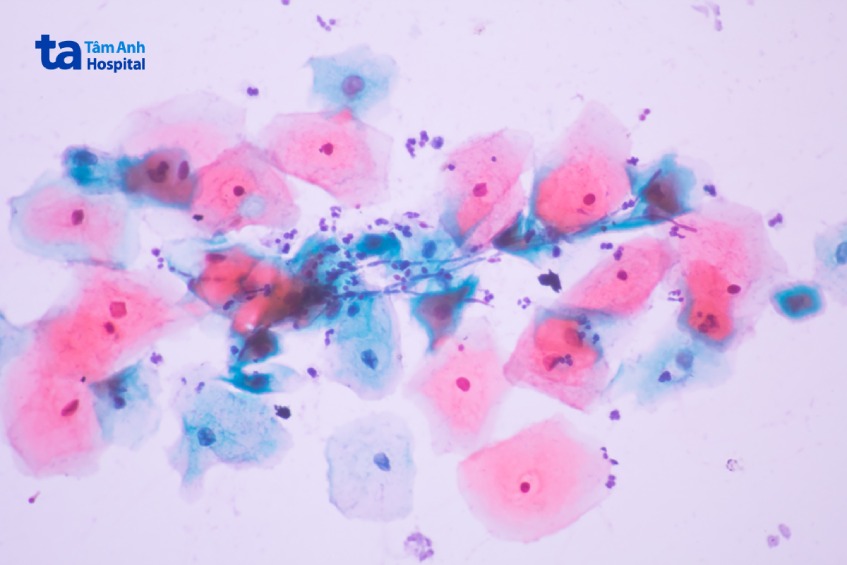 Vi khuẩn là một tác nhân gây viêm bao quy đầu