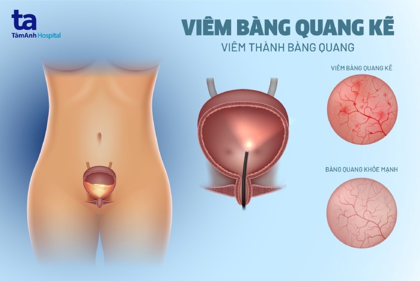 viêm bàng quang kẻ là gì