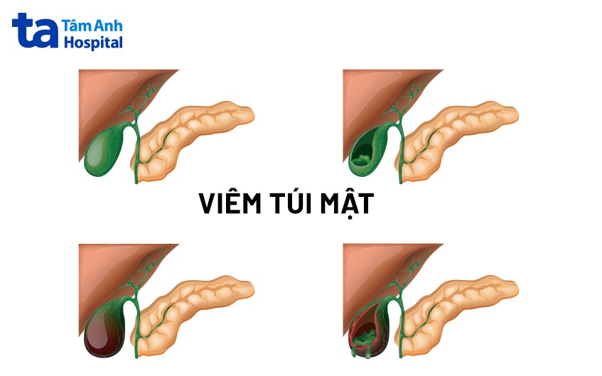 viêm túi mật