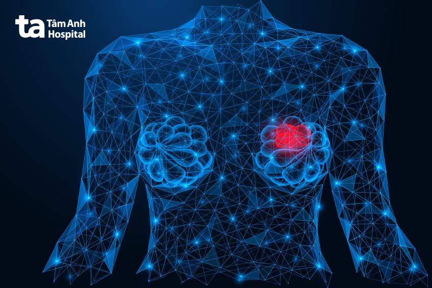 xét nghiệm sinh thiết hạch gác cửa