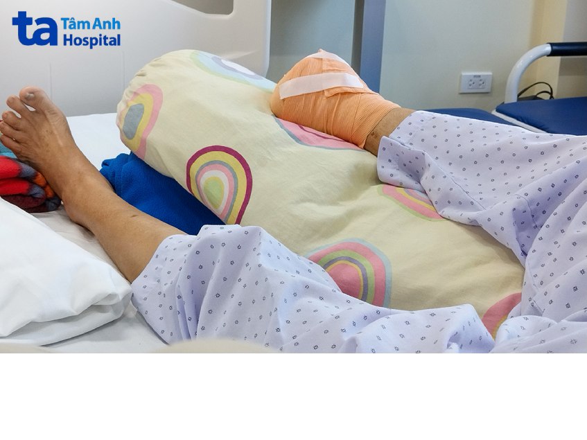 bà H. nay bị cụt 1 chân do biến chứng bệnh tiểu đường
