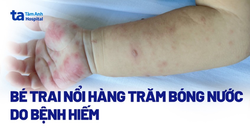 Bé trai nổi hàng trăm mụn nước do bệnh hiếm