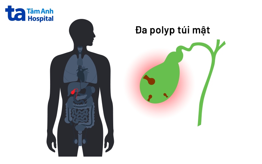 bệnh đa polyp túi mật