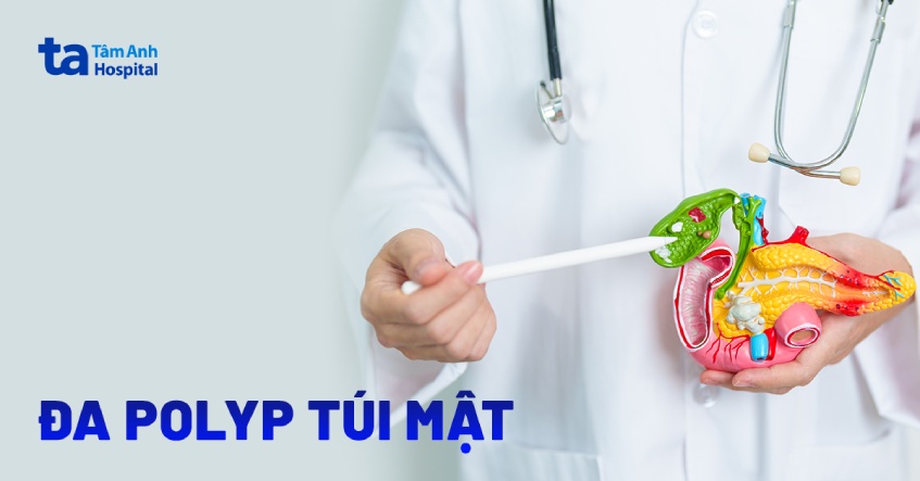 bị đa polyp túi mật