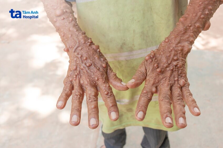 biến chứng u xơ thần kinh