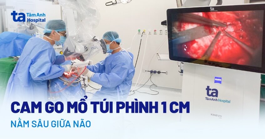 Cam go mổ túi phình 1 cm nằm sâu giữa não