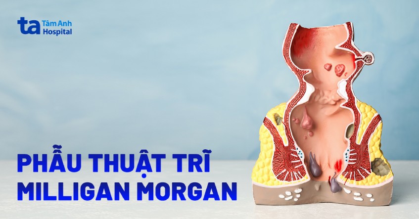 cắt trĩ bằng milligan morgan