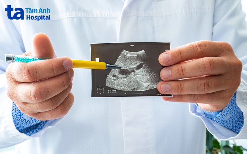 chẩn đoán túi mật sứ