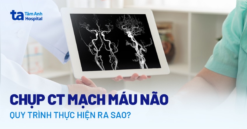 Chụp CT mạch máu não: Khi nào cần và quy trình thực hiện ra sao?