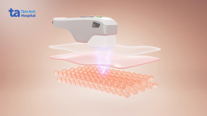 cơ chế nâng cơ xóa nọng cằm của hifu