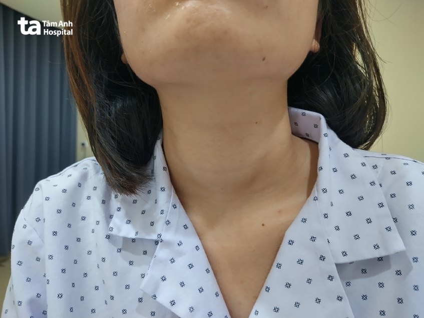 Cổ của em H. phình to do bướu giáp