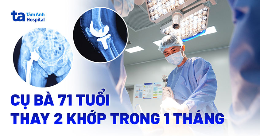 Cụ bà 71 tuổi thay hai khớp trong 1 tháng