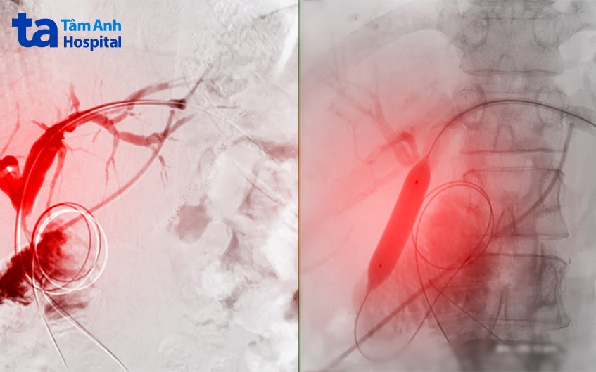 dẫn lưu túi mật qua da