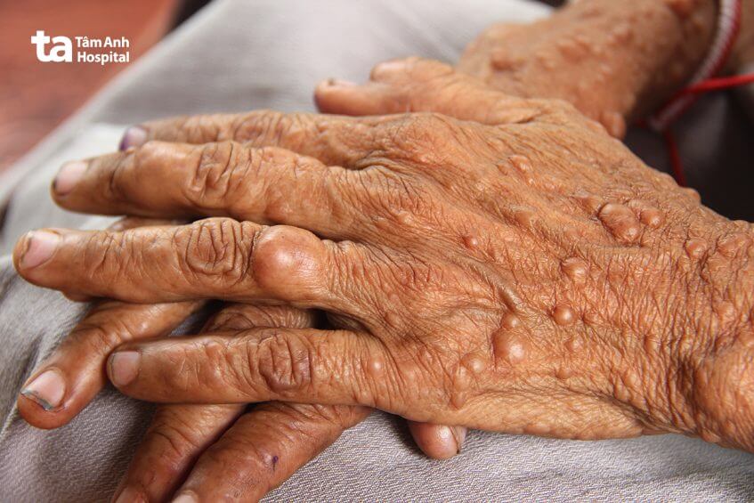 điều trị bệnh u xơ thần kinh