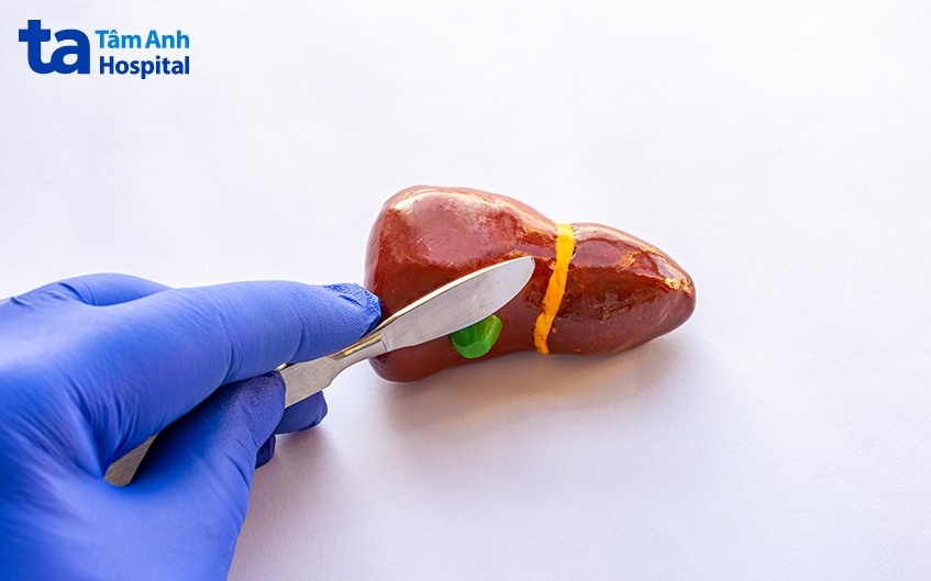 điều trị viêm túi mật hoại tử