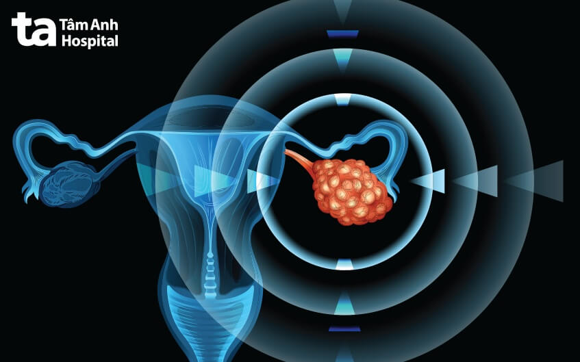 giai đoạn 2 ung thư buồng trứng