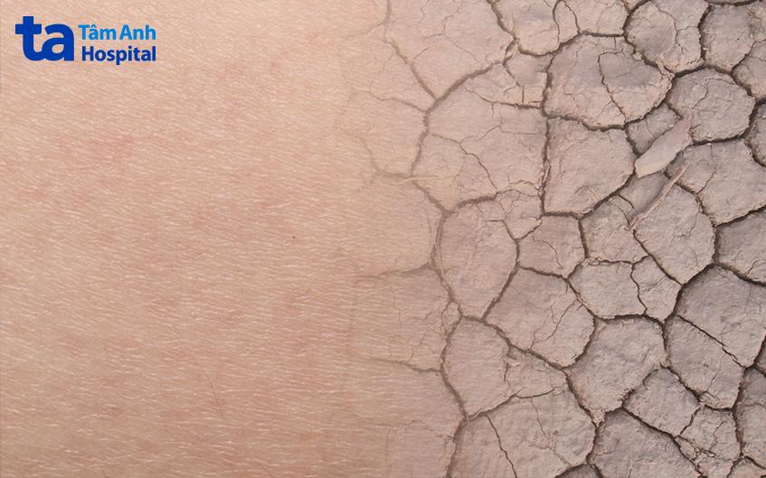 Hàng rào bảo vệ da và hệ miễn dịch suy yếu không bảo vệ được da trước tác nhân bên ngoài là một trong các yếu tố làm bùng phát viêm da cơ địa.