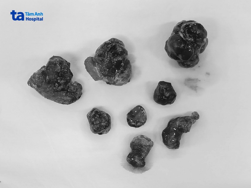 hình ảnh các viên sỏi san hô