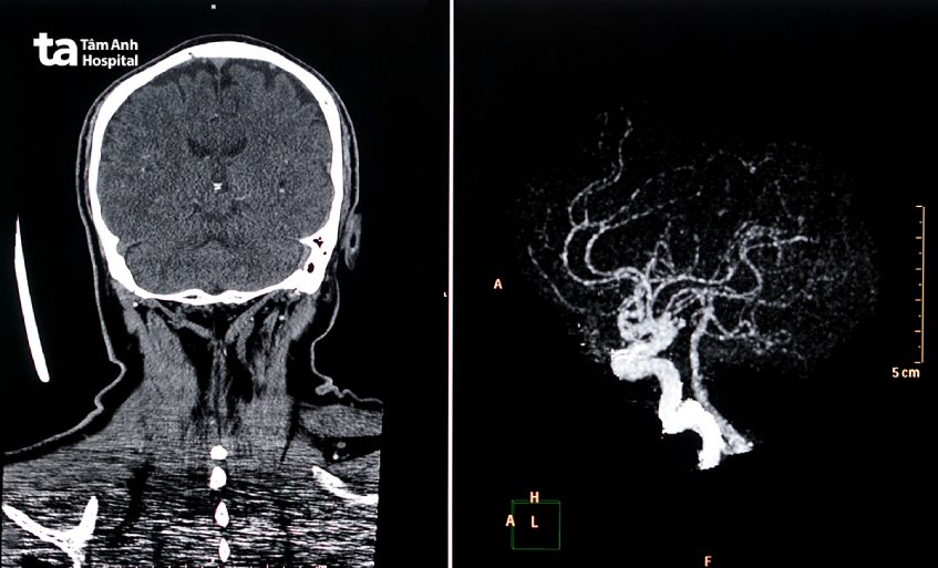 hình ảnh CT mạch máu não