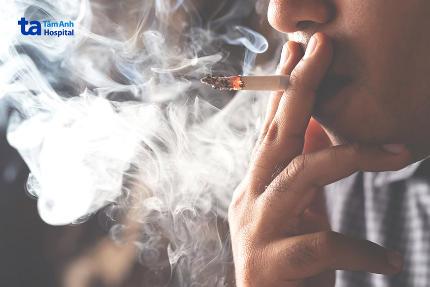 Hút thuốc lá là yếu tố nguy cơ chính của chứng phình động mạch chủ bụng