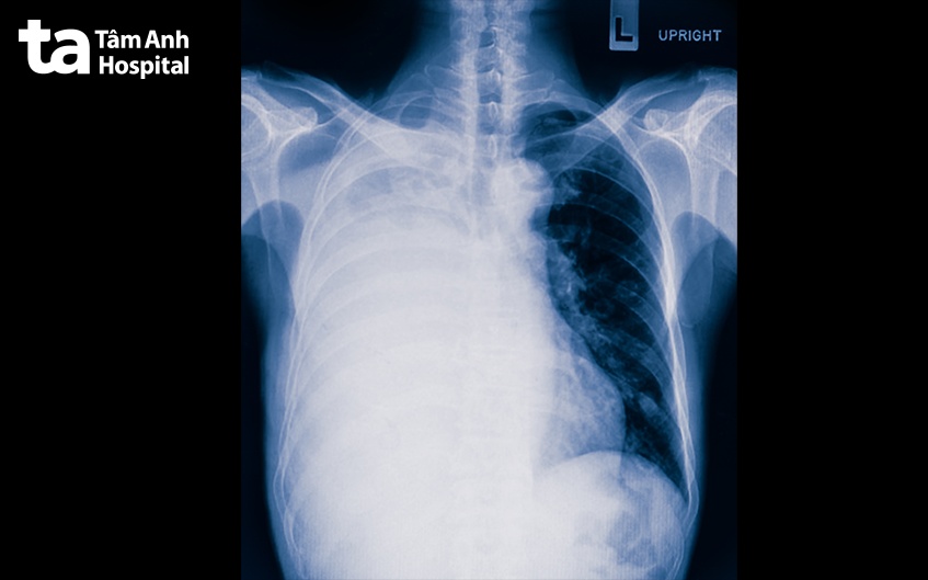 kết quả xơ phổi xquang