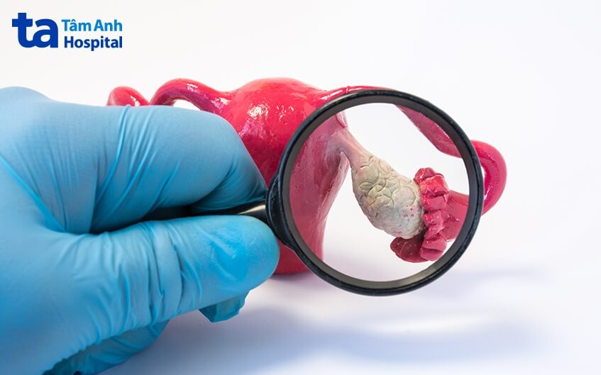 khám chẩn đoán ung thư buồng trứng giai đoạn 2