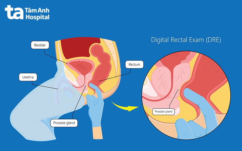 khám trực tràng