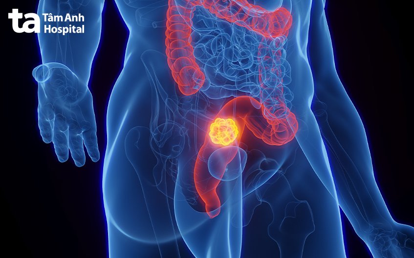 khi nào cần sinh thiết trực tràng