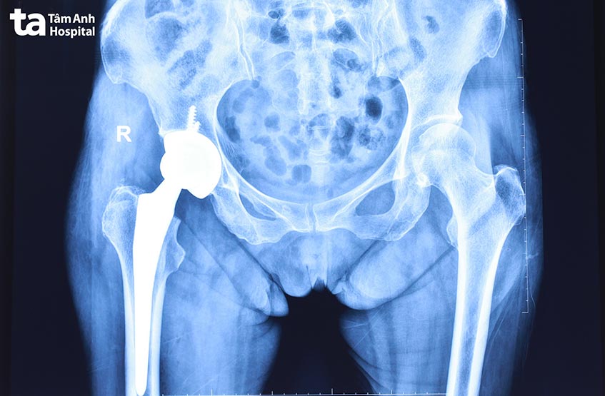 khớp háng bên phải sau khi phẫu thuật
