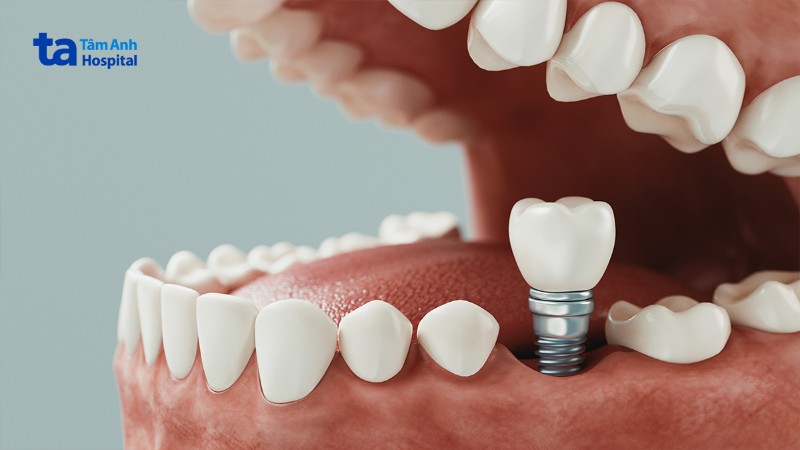 kỹ thuật phục hình răng, phục hình răng sứ trên implant