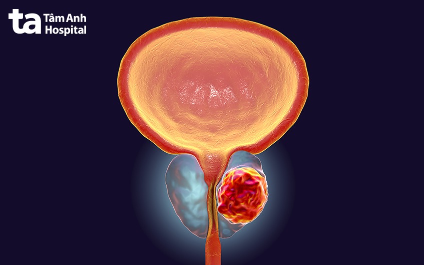 kỹ thuật sinh thiết tiền liệt tuyến