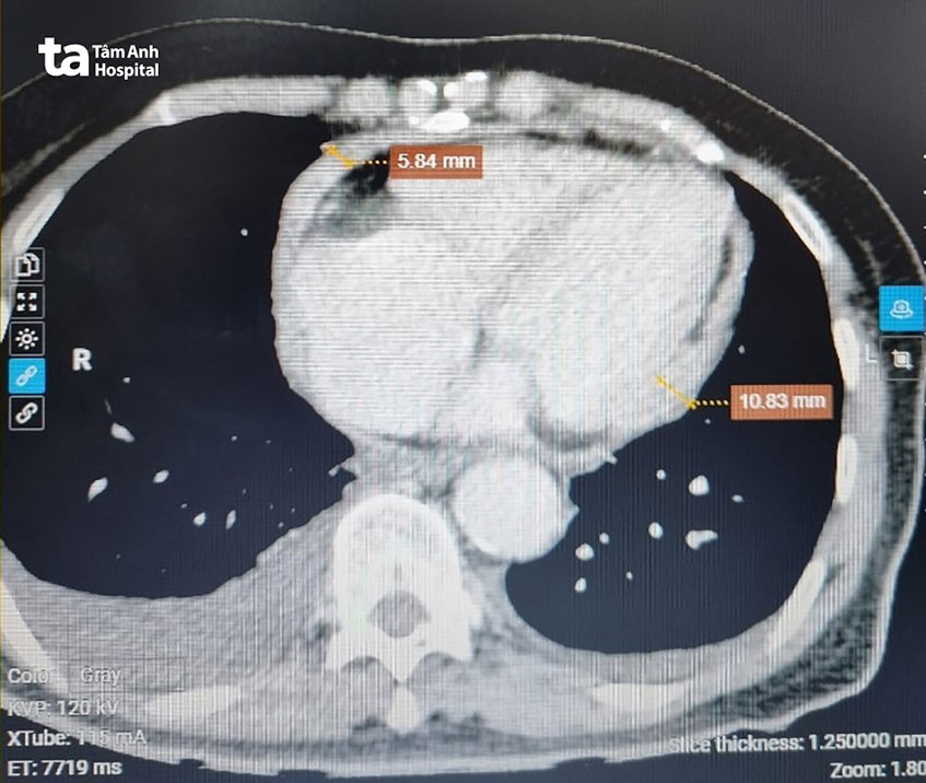 Hình ảnh lớp màng ngoài tim dày, chỗ dày nhất lên đến 10.83 mm trên phim chụp MRI tim