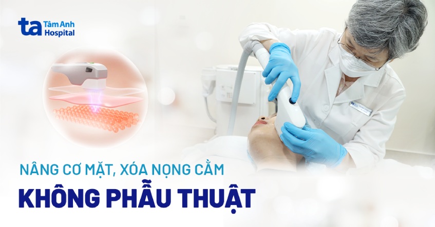 Ứng dụng sóng siêu âm để nâng cơ mặt, xóa nọng cằm không phẫu thuật