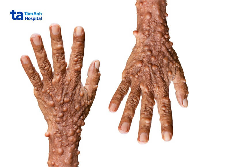 nguy cơ u xơ thần kinh