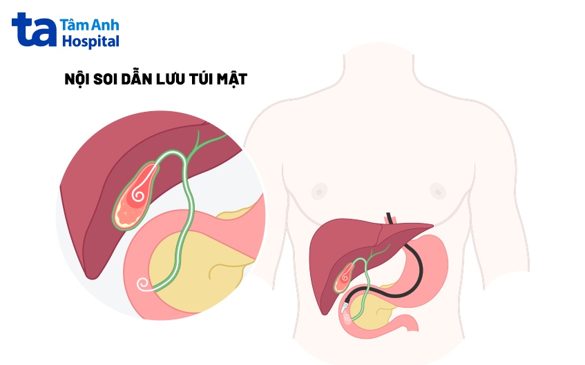 nội soi dẫn lưu túi mật