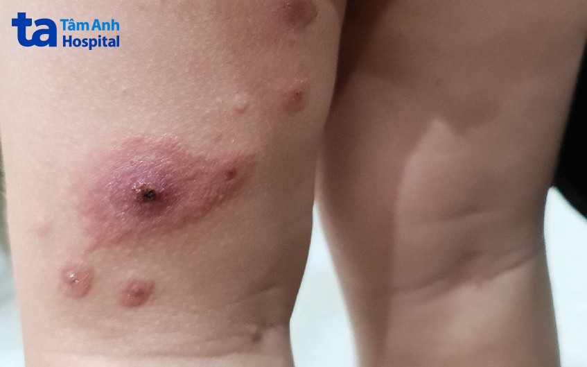 Nốt ban lớn gây ngứa, trẻ gãi nhiều gây tróc vảy ở một ca bệnh khác