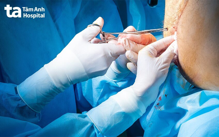 phẫu thuật cắt trĩ theo phương pháp milligan morgan