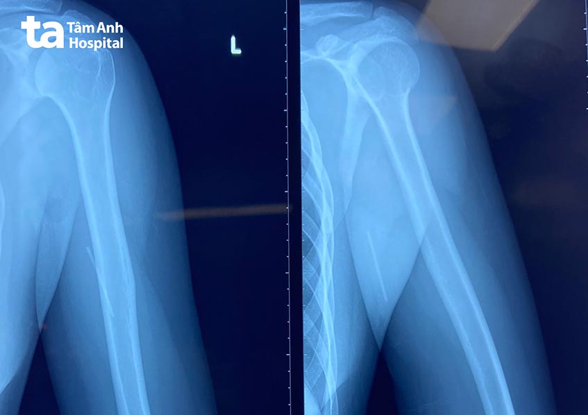 que cấy tránh thai đã đi sâu vào bắp tay