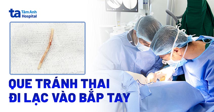 Que tránh thai đi lạc vào bắp tay
