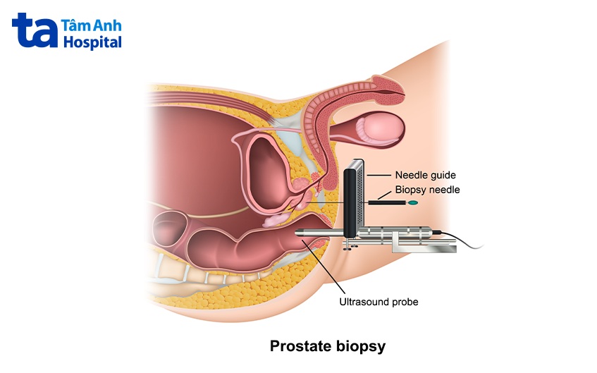 quy trình sinh thiết tuyến tiền liệt