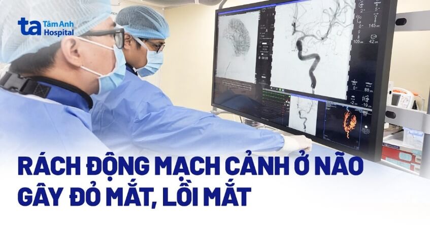 Rách động mạch cảnh ở não gây đỏ mắt, lồi mắt