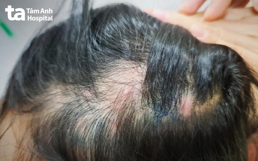 Sau 5 ngày điều trị kháng sinh uống và thuốc bôi ngoài da, các nốt nhọt đã lành, khô ráo, trẻ hết đau.