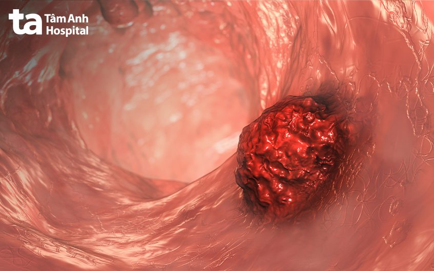 sinh thiết đại tràng chẩn đoán ung thư